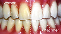 Bild - Bleaching